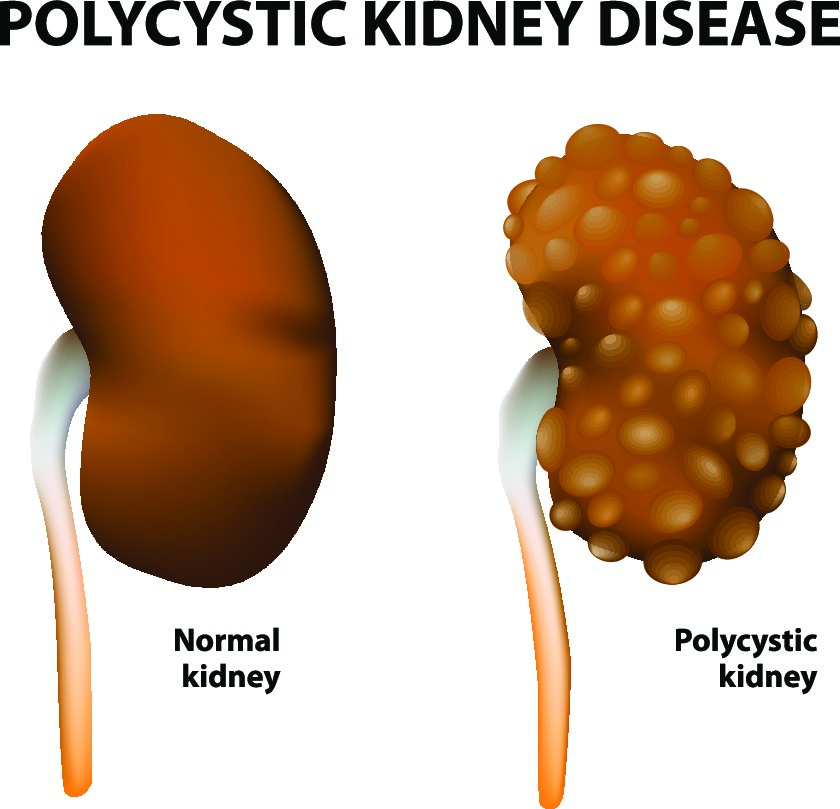โรคไต Polycystic คืออะไร? สาเหตุ ประเภท อาการ และการรักษา